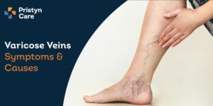 Varicose-Veins-Symptoms-and-Causes