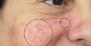 womans-face-with-broken-capillaries-q5se9k9n4qyxkmnm32hld1qw6w0z9xslvnqcd34zvk